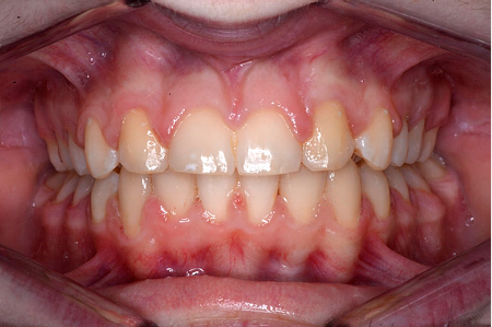 Implant crown replacing missing tooth with natural gum emergence
