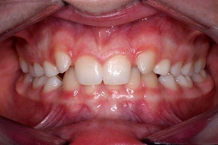 Missing lateral incisor hypodontia before implant rehabilitation