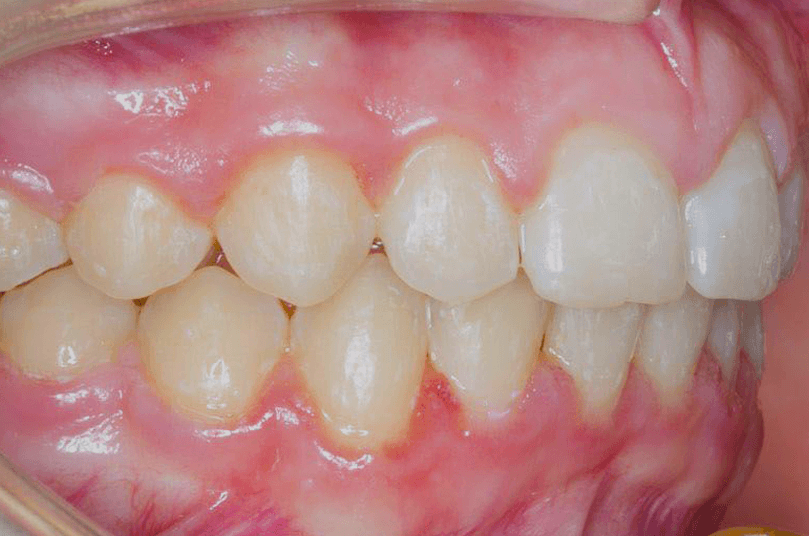 Retracted balanced incisors after specialist orthodontic care