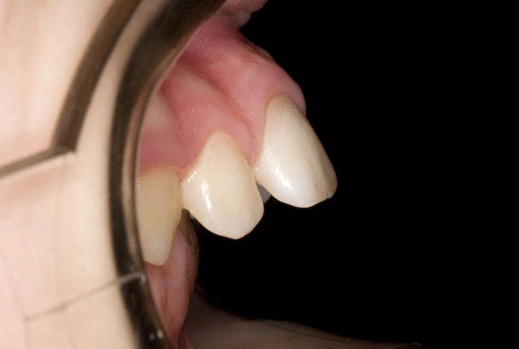 Protruding front teeth overjet before specialist braces