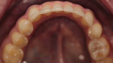 Symmetrical teeth alignment after Invisalign
