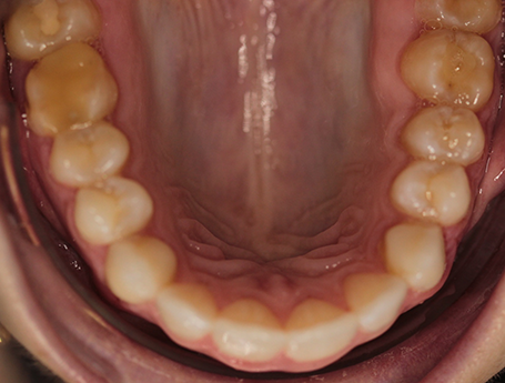 Aligned dental arch after orthodontic treatment