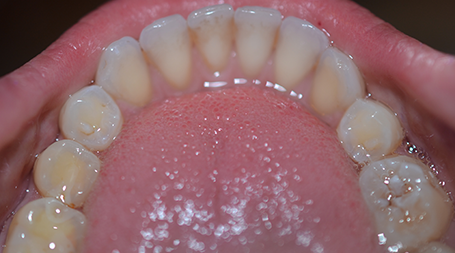 Irregular bite and rotated front teeth before Invisalign