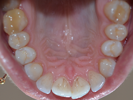 Anterior dental crowding before orthodontic treatment